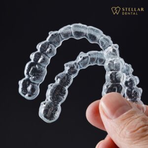 Stellar Dental - Clear Aligners (Moderate)